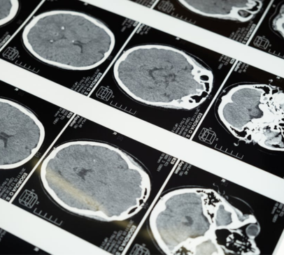 New Lancet Commission on dementia, including TBI as risk factor Main Image