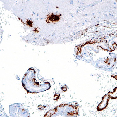 Head injury patients develop brain clumps associated with Alzheimer’s disease Main Image