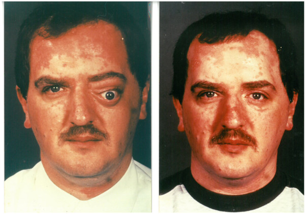Arthur Moore after and before the accident