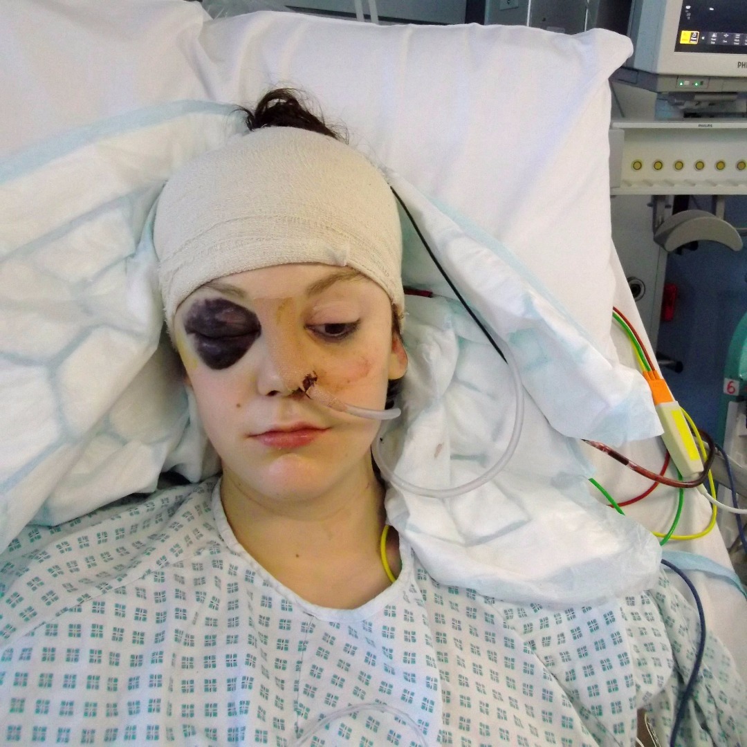 Surgeons removed a large blood clot from Naomi's brain