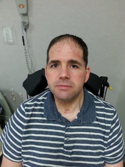 Part of Alan's skull had to be removed because of the pressure on his brain