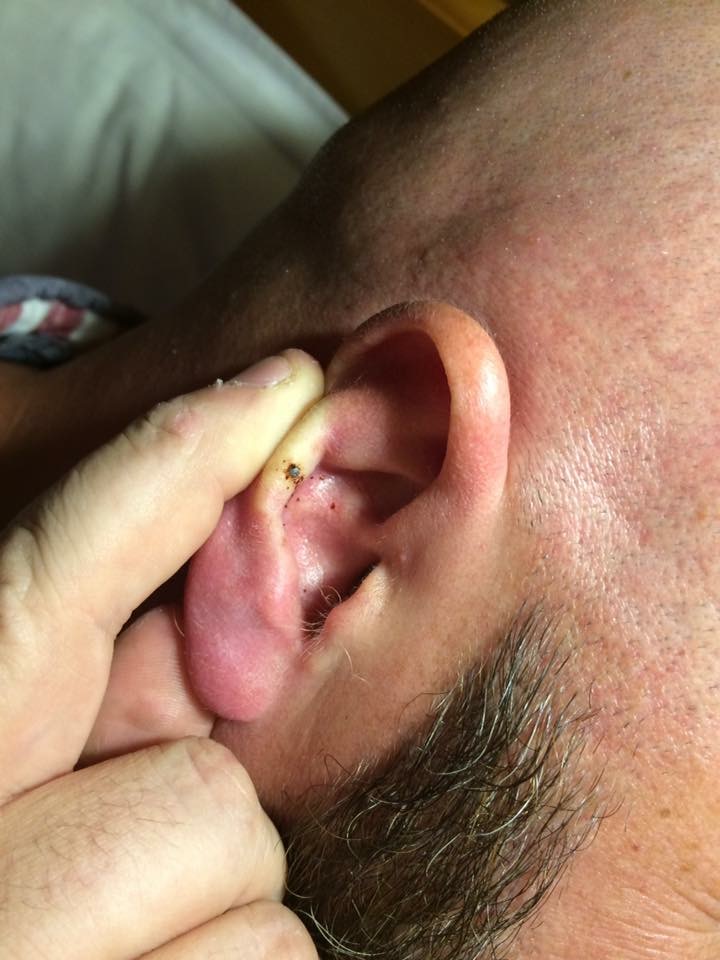 The tick embedded in Keith's ear
