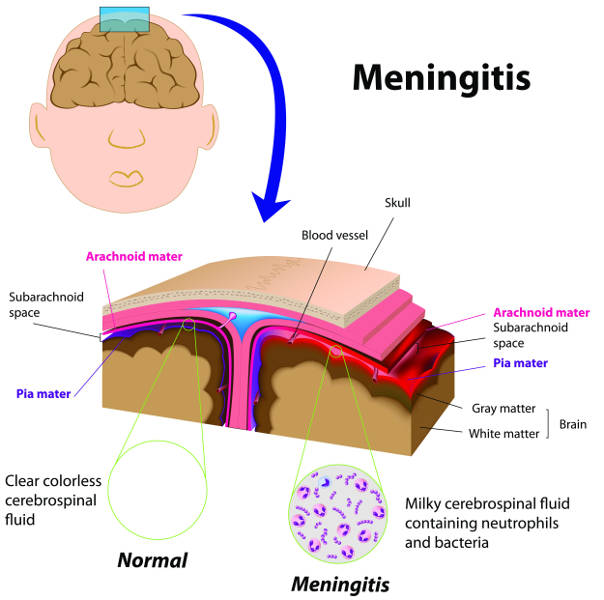 Diagram showing how meningitis affects the brain, including the meninges around the brain (copyright shutterstock_89870962)