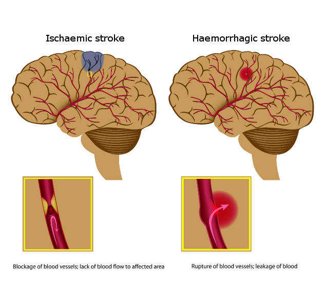 Human Brain After Stroke