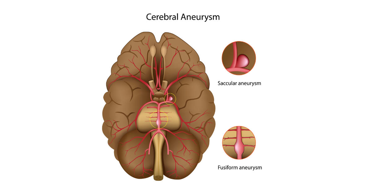 Brain Aneurysm