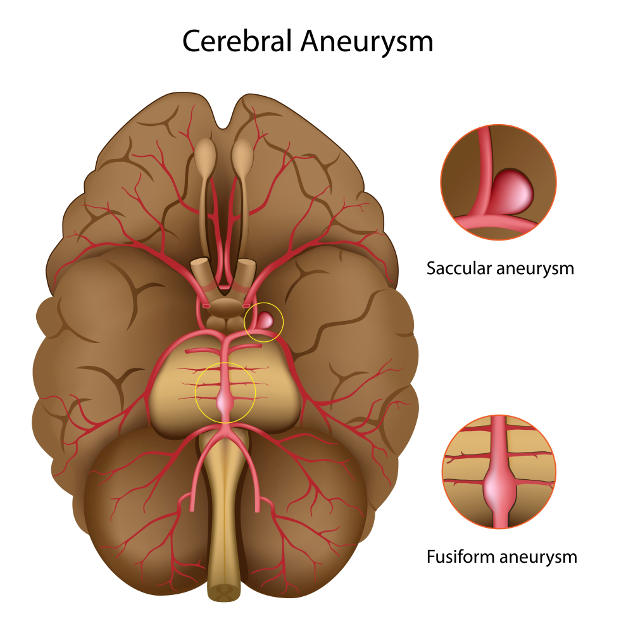 Brain Aneurysm Size Chart