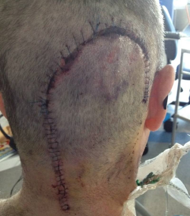 Ron's post-'head pop' scar