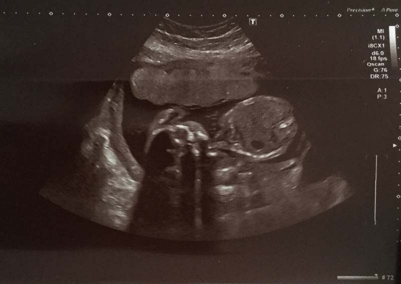 Lisa's baby