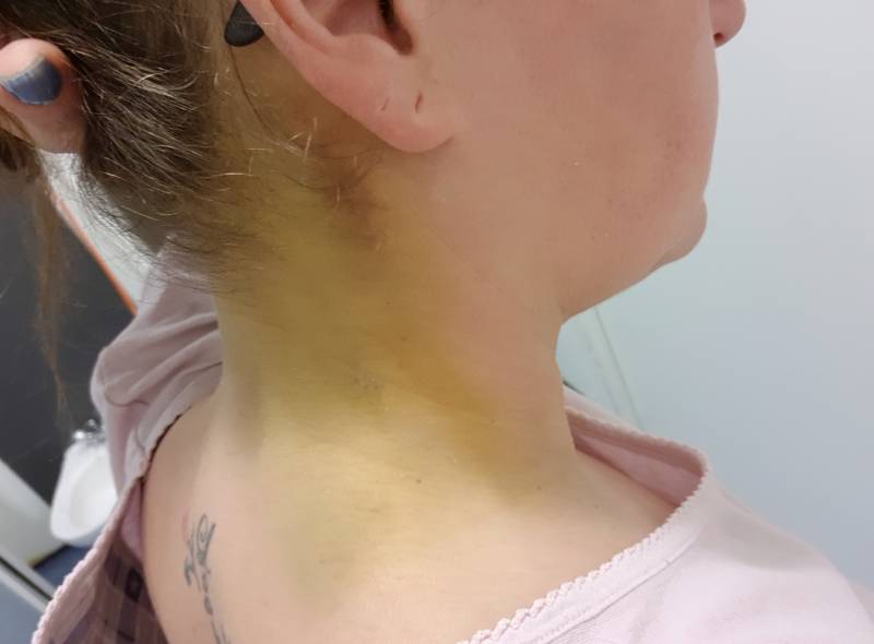 Tracey's bruises