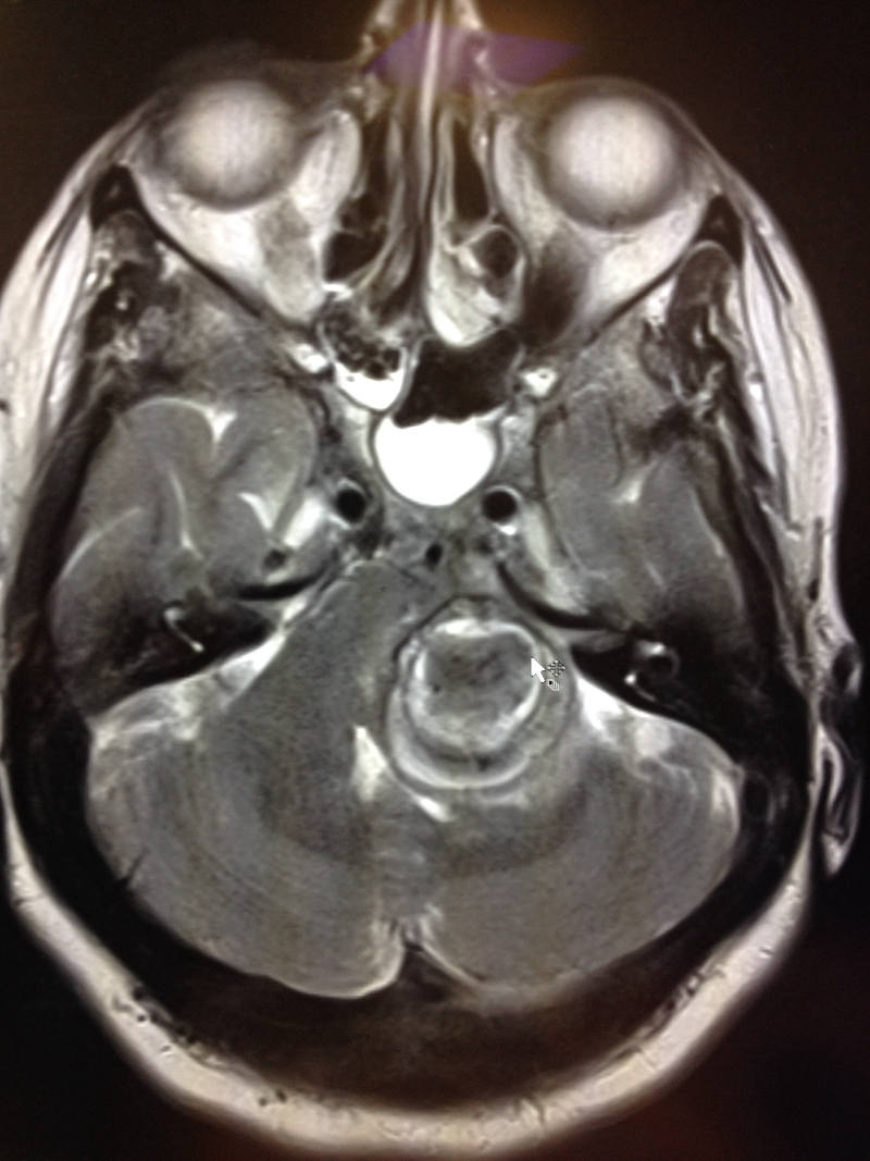 An MRI scan showed the cavernoma on Sandra's brain