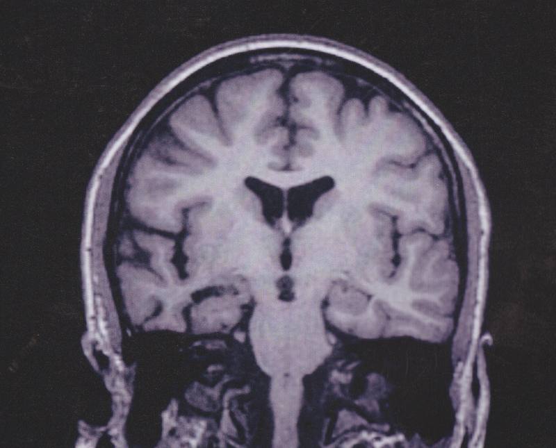 A scan of Imogen's brain