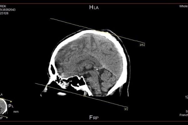 Derek's brain scan shows the severity of his injury