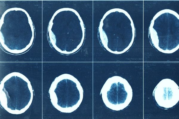 Scans show the extent of Thomas' brain injury