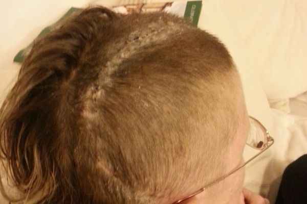 A photograph of the shaved top of Bernadette's head shows a large scar from the brain surgery.