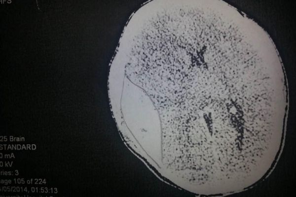 A scan of Bernadette's brain shows a large area of damage has occured.